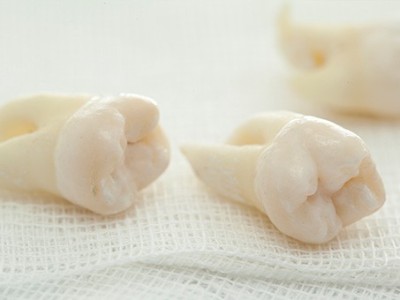 智齒疼了，這牙非拔不可嗎？