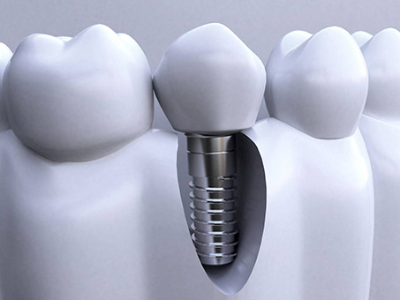 承德種植牙價格表，2024種植牙多少錢一顆呢?