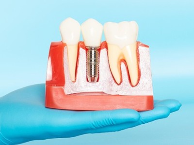 種牙VS鑲牙，你適合哪種?